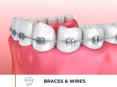 Braces and wires